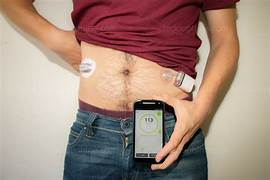 pompe à insuline + smartphone